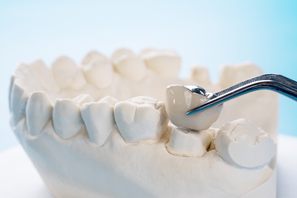 Signs Of Damaged Dental Crowns
