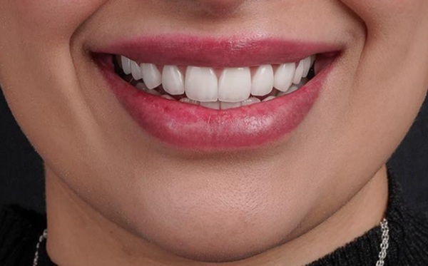 How A Smile Makeover Can Transform Your Confidence