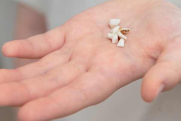 Broken Tooth Emergency Guide: What To Do Now And How Dentists Repair It