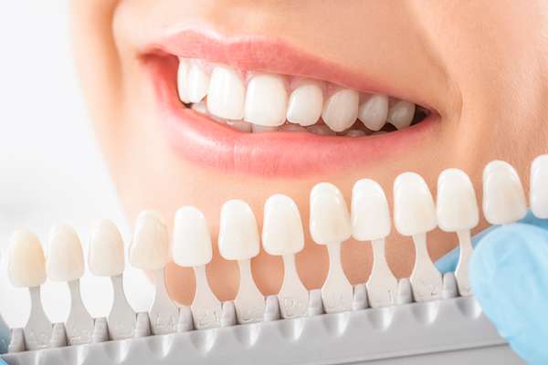 Caring for Veneers After a Cosmetic Dentist Treatment from McCarthy Dentistry in Marietta, OH