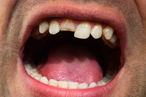 Can A Chipped Tooth Be Left Untreated?