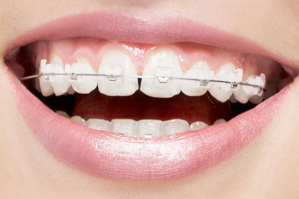What Advantages Do Clear Braces Have Over Aligners?
