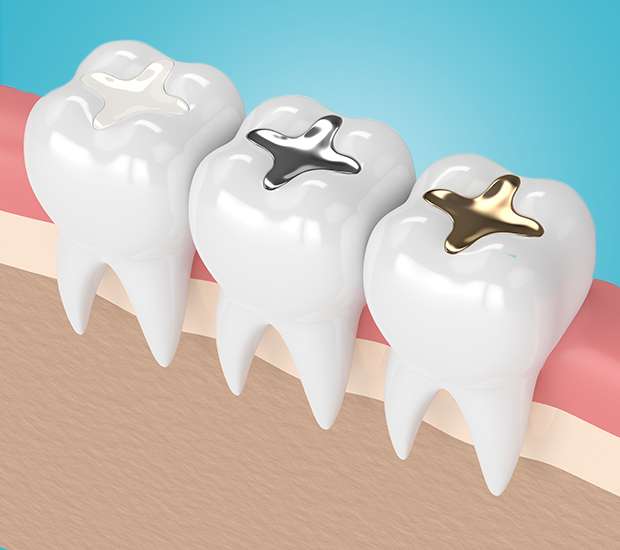 Marietta Composite Fillings