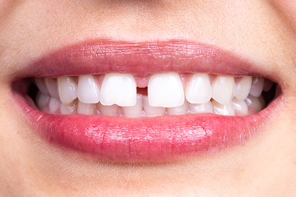 How Dental Bonding Is Used To Minimize Gaps In Front Teeth