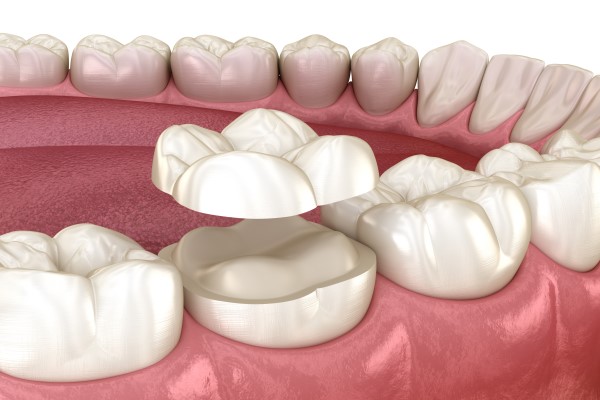 Replacing A Worn Out Dental Filling With A Crown