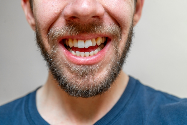 Dental Crowns For Cracked Or Fractured Teeth