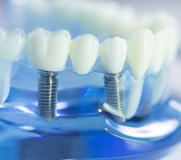 Marietta Dental Implants