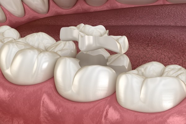When Would A Dentist Recommend A Dental Inlay?