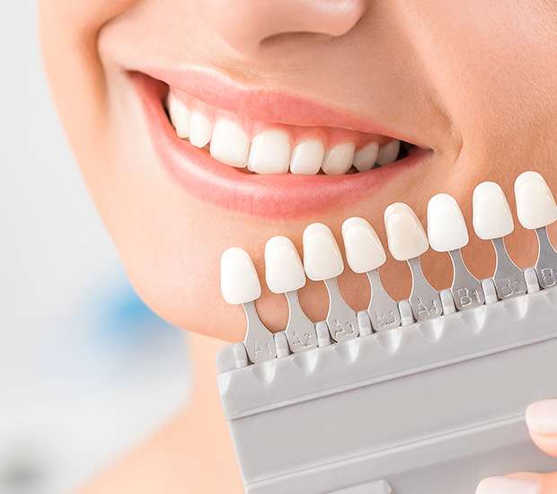 Marietta Dental Veneers and Dental Laminates