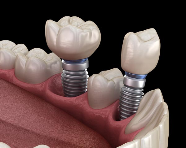 dental implants