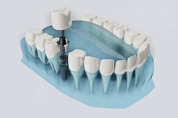 FAQs about Dental Implants from McCarthy Dentistry in Marietta, OH