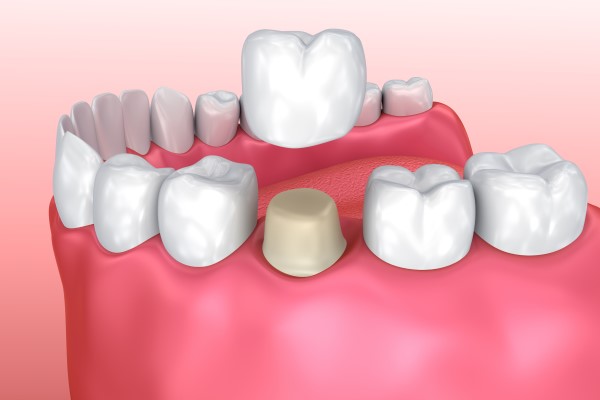 General Dentistry &#    ; When Is A Dental Crown Recommended?