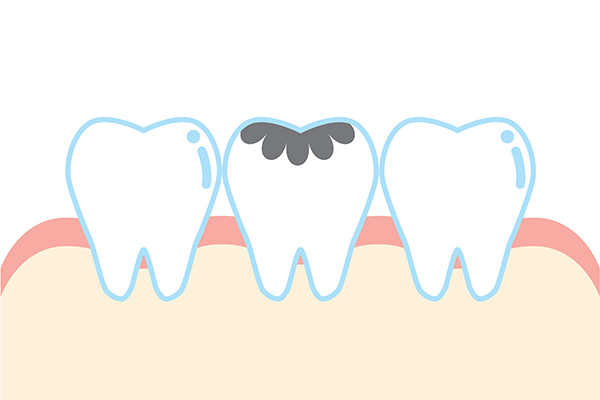 Dental Practice FAQs: How Are Cavities Treated? from McCarthy Dentistry in Marietta, OH