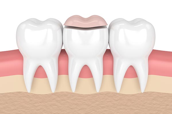 How a Cosmetic Dentist Can Place Inlays and Onlays from McCarthy Dentistry in Marietta, OH