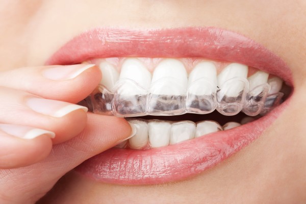 Four Reasons To Choose Invisalign