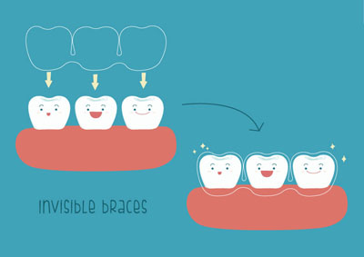 The Facts From An Invisalign® Dentist