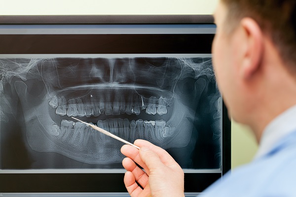 What Is Dental Implant Oral Surgery?