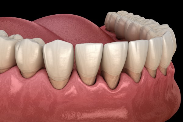 How Periodontics Promotes Healthy Gums