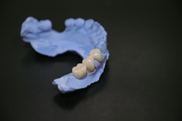 A Step By Step Guide To Getting Dental Crowns