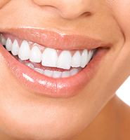 Teeth Whitening Services Marietta, OH