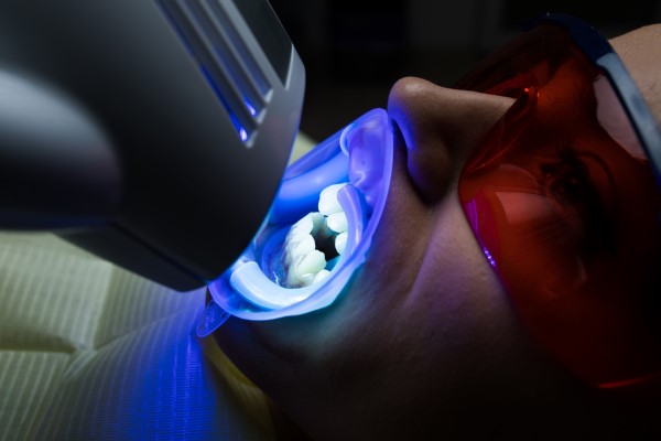 Teeth Whitening: In Office Vs  At Home—Which Gives Better Results?