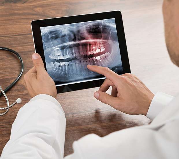 Marietta Types of Dental Root Fractures