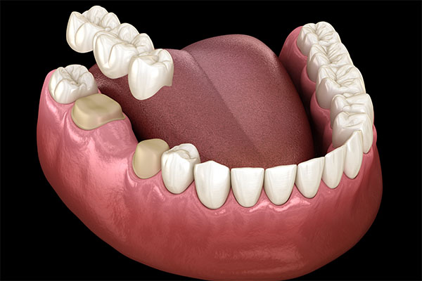 When a Dental Bridge Is a Cosmetic Dental Services Option from McCarthy Dentistry in Marietta, OH