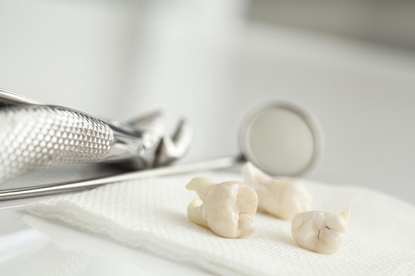 Here Are   Facts About Wisdom Tooth Extraction